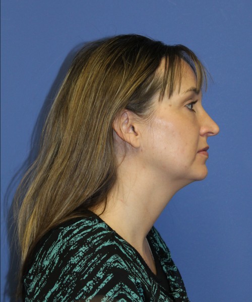 Rhinoplasty 1443 – Click HERE for more views before photo. Individual results may vary.