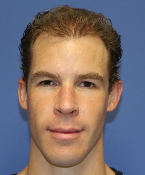 Rhinoplasty 1506 – Click HERE for more views after photo. Individual results may vary.