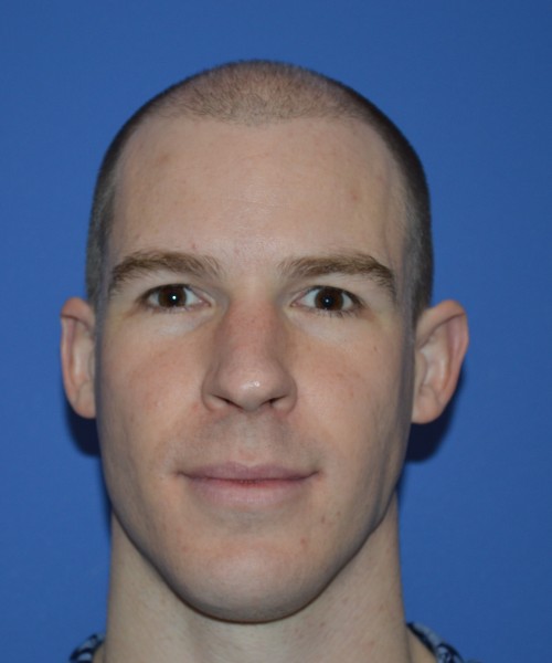 Rhinoplasty 1506 – Click HERE for more views before photo. Individual results may vary.