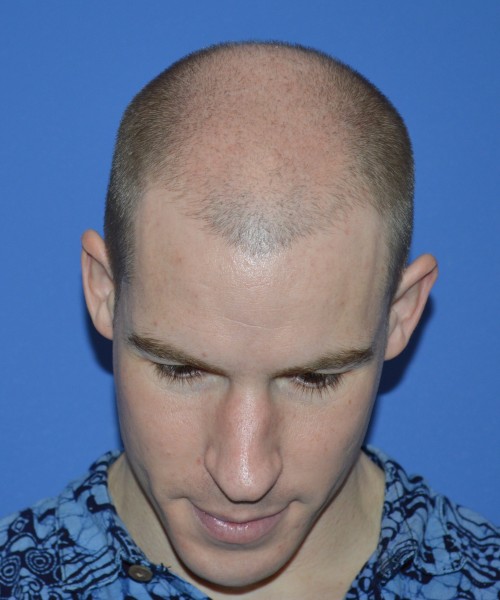 Rhinoplasty 1506 – Click HERE for more views before photo. Individual results may vary.