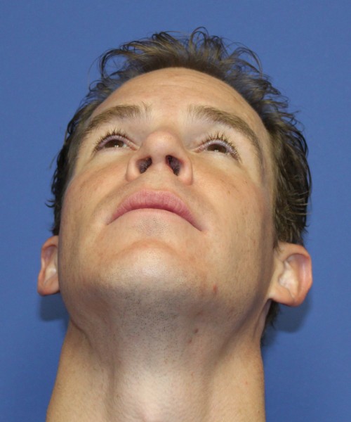 Rhinoplasty 1506 – Click HERE for more views after photo. Individual results may vary.