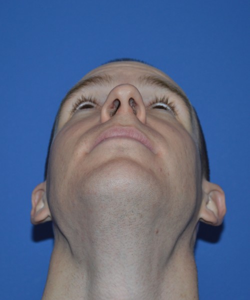 Rhinoplasty 1506 – Click HERE for more views before photo. Individual results may vary.