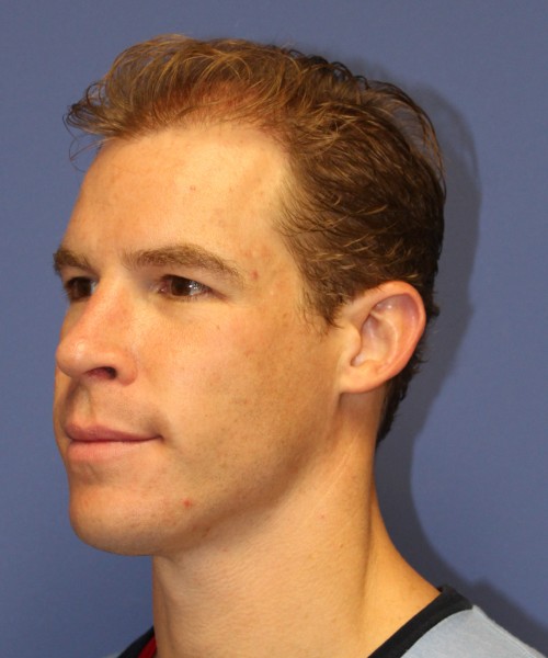 Rhinoplasty 1506 – Click HERE for more views after photo. Individual results may vary.