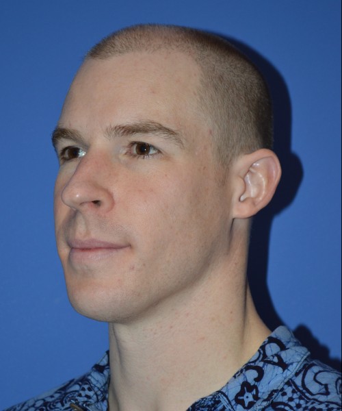 Rhinoplasty 1506 – Click HERE for more views before photo. Individual results may vary.