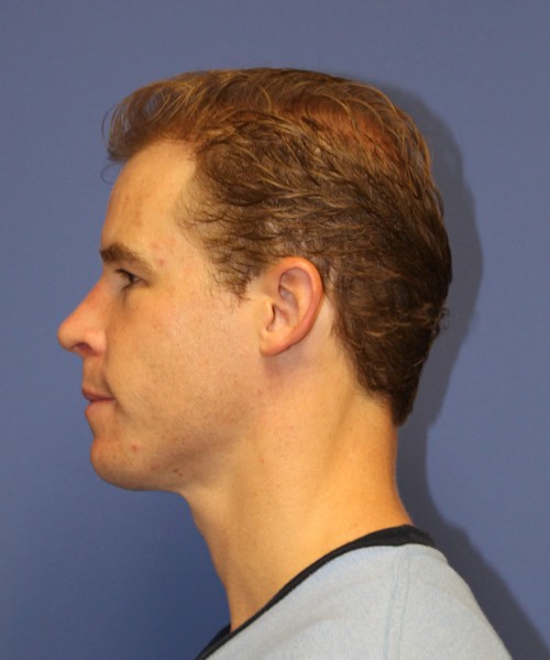 Rhinoplasty 1506 – Click HERE for more views after photo. Individual results may vary.