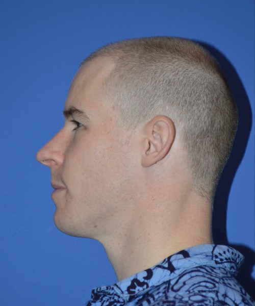 Rhinoplasty 1506 – Click HERE for more views before photo. Individual results may vary.