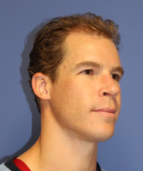 Rhinoplasty 1506 – Click HERE for more views after photo. Individual results may vary.