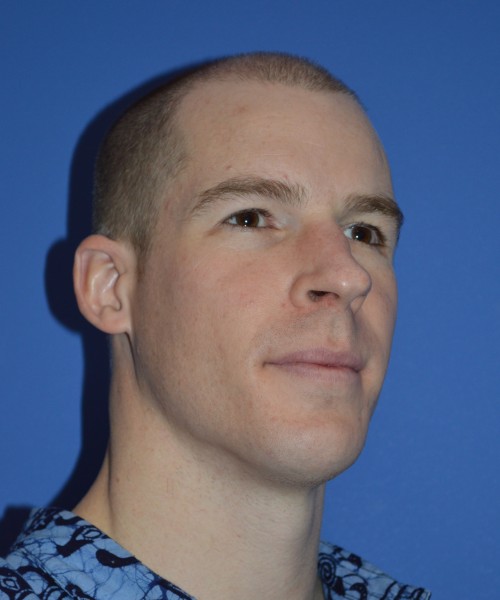 Rhinoplasty 1506 – Click HERE for more views before photo. Individual results may vary.