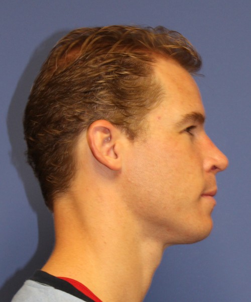 Rhinoplasty 1506 – Click HERE for more views after photo. Individual results may vary.
