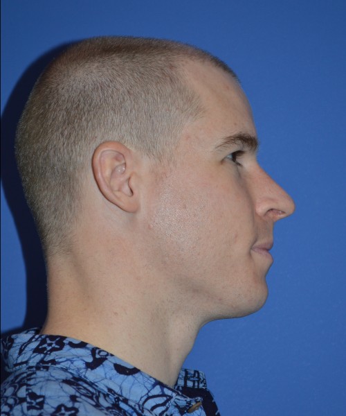 Rhinoplasty 1506 – Click HERE for more views before photo. Individual results may vary.