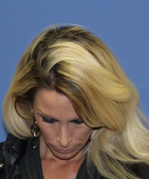 Rhinoplasty 1508 – Click HERE for more views after photo. Individual results may vary.