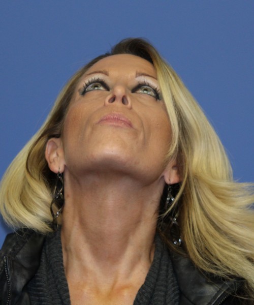 Rhinoplasty 1508 – Click HERE for more views after photo. Individual results may vary.