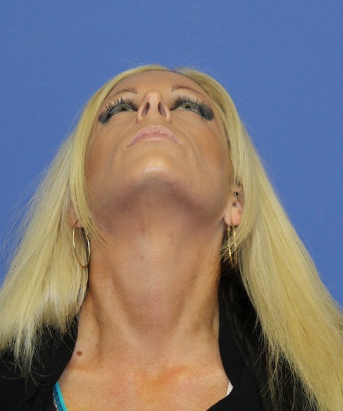 Rhinoplasty 1508 – Click HERE for more views before photo. Individual results may vary.