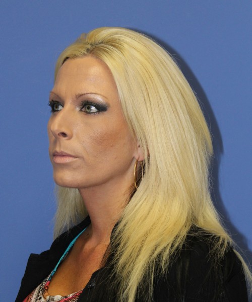 Rhinoplasty 1508 – Click HERE for more views before photo. Individual results may vary.
