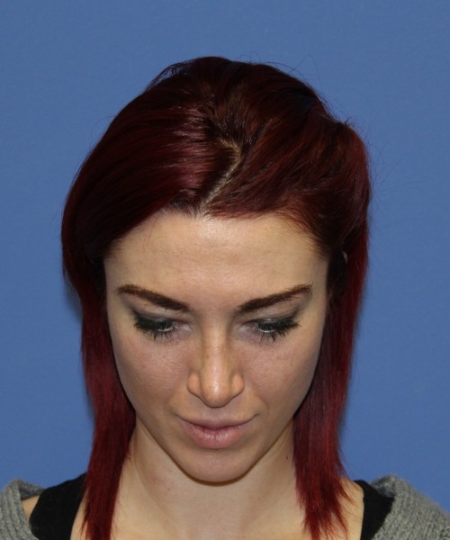 Rhinoplasty 1509 – Click HERE for more views after photo. Individual results may vary.