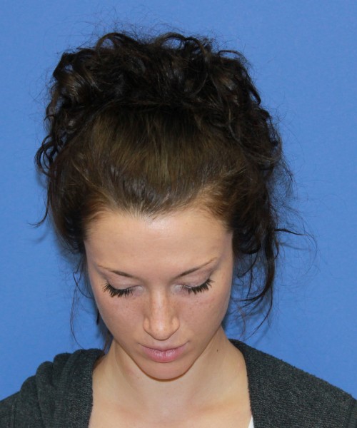 Rhinoplasty 1509 – Click HERE for more views before photo. Individual results may vary.