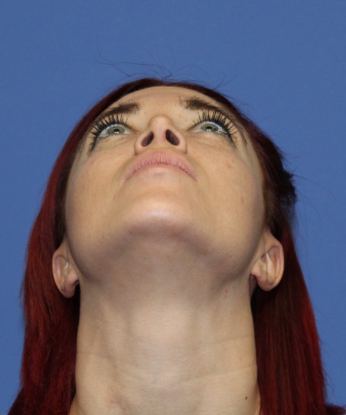 Rhinoplasty 1509 – Click HERE for more views after photo. Individual results may vary.