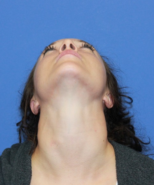 Rhinoplasty 1509 – Click HERE for more views before photo. Individual results may vary.