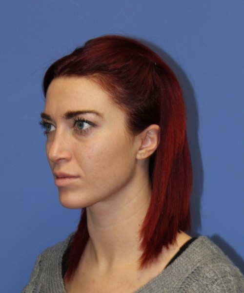 Rhinoplasty 1509 – Click HERE for more views after photo. Individual results may vary.
