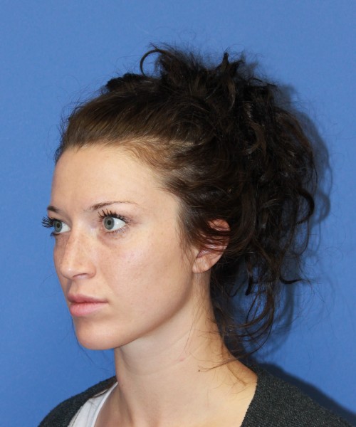 Rhinoplasty 1509 – Click HERE for more views before photo. Individual results may vary.
