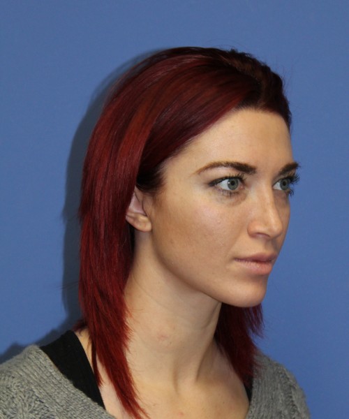 Rhinoplasty 1509 – Click HERE for more views after photo. Individual results may vary.
