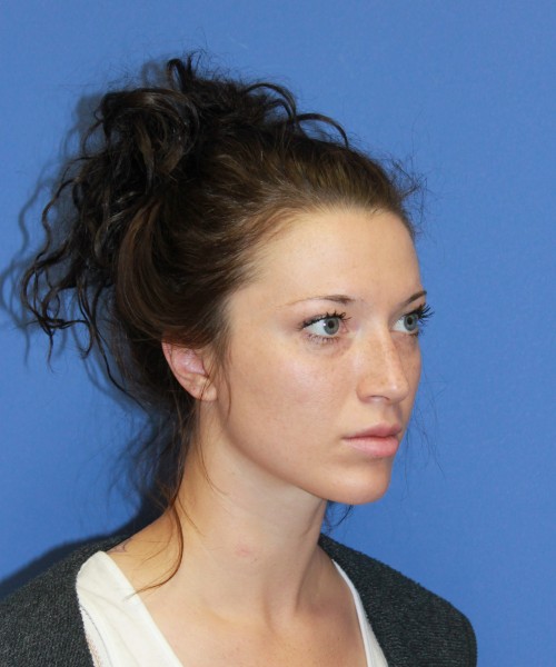 Rhinoplasty 1509 – Click HERE for more views before photo. Individual results may vary.