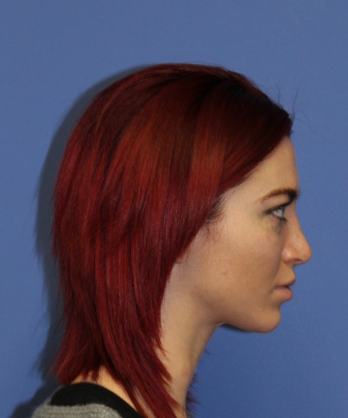 Rhinoplasty 1509 – Click HERE for more views after photo. Individual results may vary.
