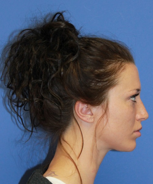 Rhinoplasty 1509 – Click HERE for more views before photo. Individual results may vary.