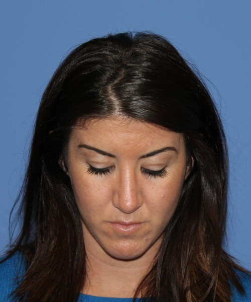 Rhinoplasty 1588 – Click HERE for more views after photo. Individual results may vary.