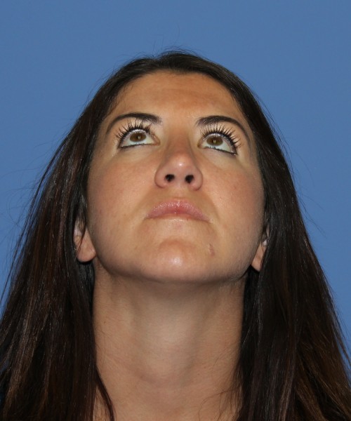 Rhinoplasty 1588 – Click HERE for more views after photo. Individual results may vary.