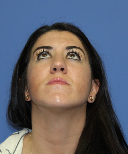 Rhinoplasty 1588 – Click HERE for more views before photo. Individual results may vary.