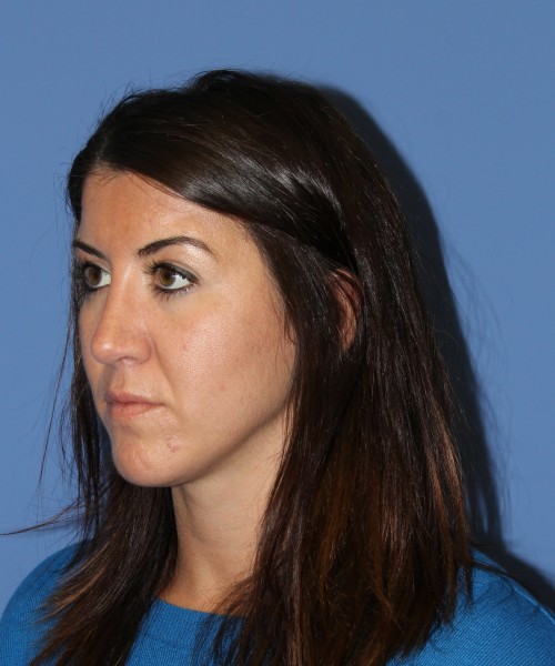 Rhinoplasty 1588 – Click HERE for more views after photo. Individual results may vary.