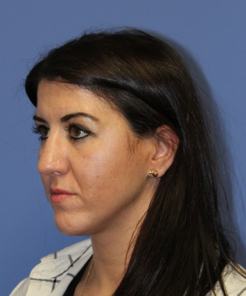 Rhinoplasty 1588 – Click HERE for more views before photo. Individual results may vary.