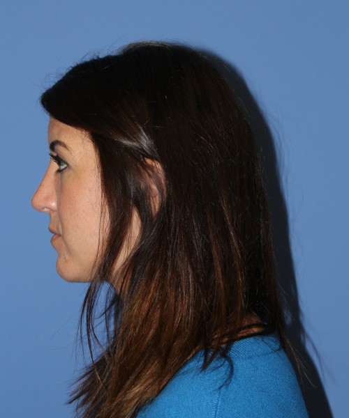Rhinoplasty 1588 – Click HERE for more views after photo. Individual results may vary.