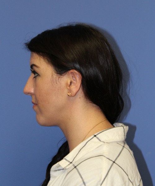Rhinoplasty 1588 – Click HERE for more views before photo. Individual results may vary.