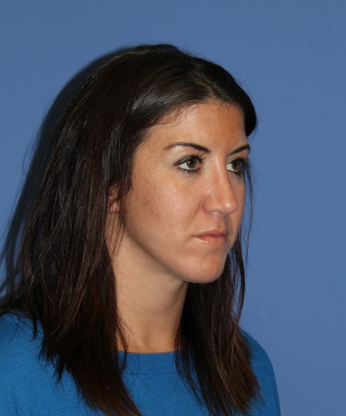 Rhinoplasty 1588 – Click HERE for more views after photo. Individual results may vary.