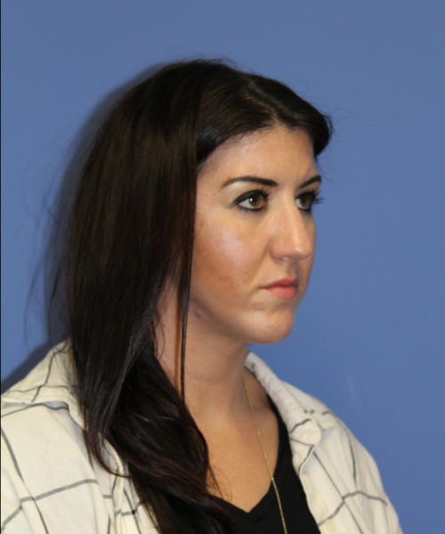 Rhinoplasty 1588 – Click HERE for more views before photo. Individual results may vary.