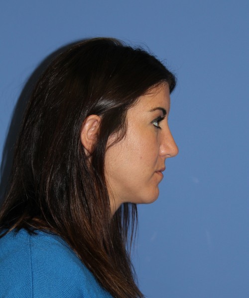 Rhinoplasty 1588 – Click HERE for more views after photo. Individual results may vary.