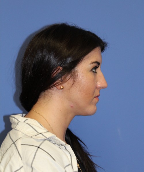 Rhinoplasty 1588 – Click HERE for more views before photo. Individual results may vary.