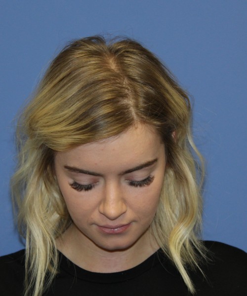 Rhinoplasty 1589 – Click HERE for more views after photo. Individual results may vary.