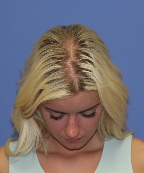 Rhinoplasty 1589 – Click HERE for more views before photo. Individual results may vary.