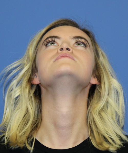 Rhinoplasty 1589 – Click HERE for more views after photo. Individual results may vary.