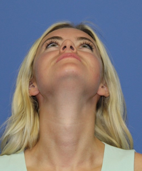 Rhinoplasty 1589 – Click HERE for more views before photo. Individual results may vary.