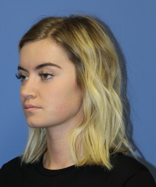 Rhinoplasty 1589 – Click HERE for more views after photo. Individual results may vary.