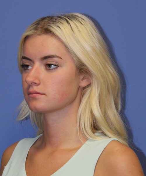 Rhinoplasty 1589 – Click HERE for more views before photo. Individual results may vary.