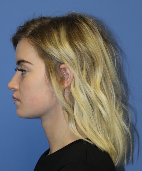 Rhinoplasty 1589 – Click HERE for more views after photo. Individual results may vary.
