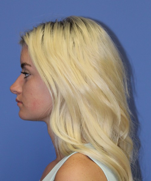 Rhinoplasty 1589 – Click HERE for more views before photo. Individual results may vary.