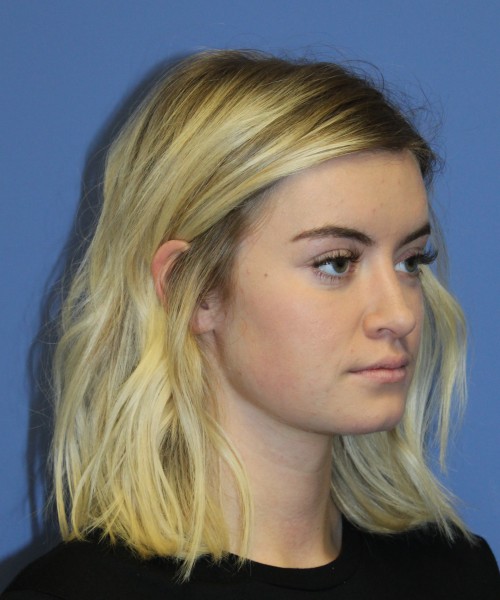Rhinoplasty 1589 – Click HERE for more views after photo. Individual results may vary.