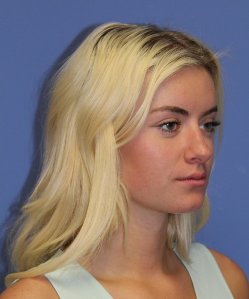 Rhinoplasty 1589 – Click HERE for more views before photo. Individual results may vary.
