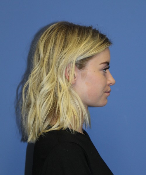 Rhinoplasty 1589 – Click HERE for more views after photo. Individual results may vary.